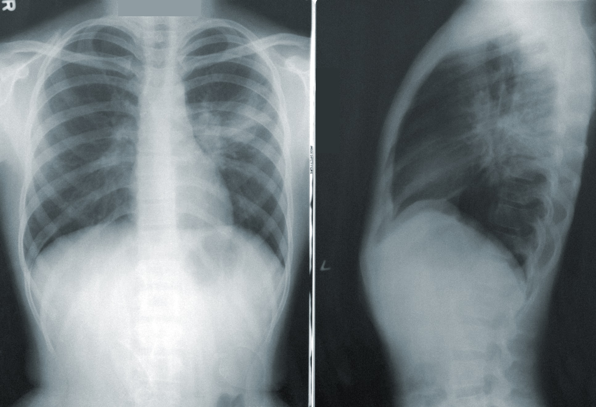 lung-x-ray